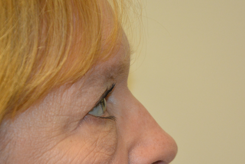Eyelid-Surgery-06 | After Eyelid Surgery 5