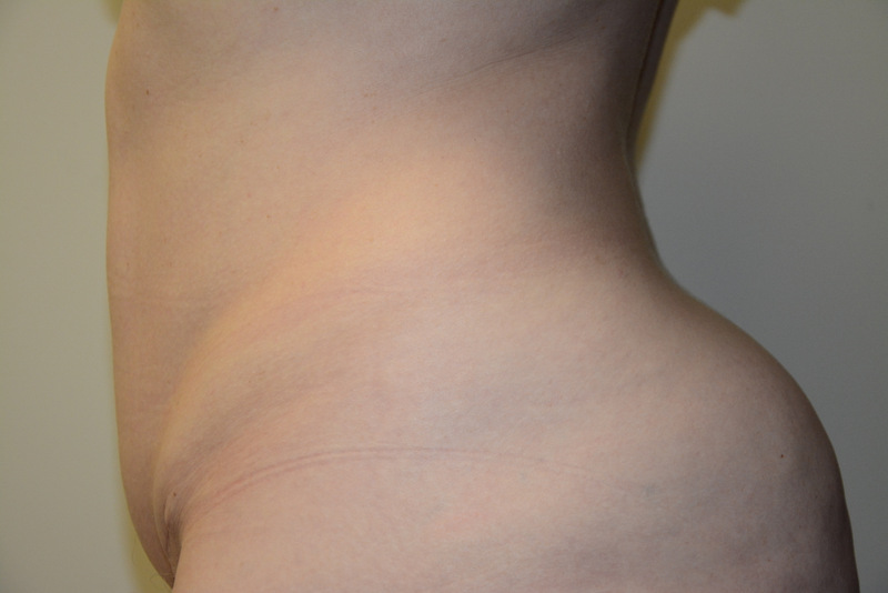 Mini-Tummy-Tuck-05 | After Mini Tummy Tuck 3