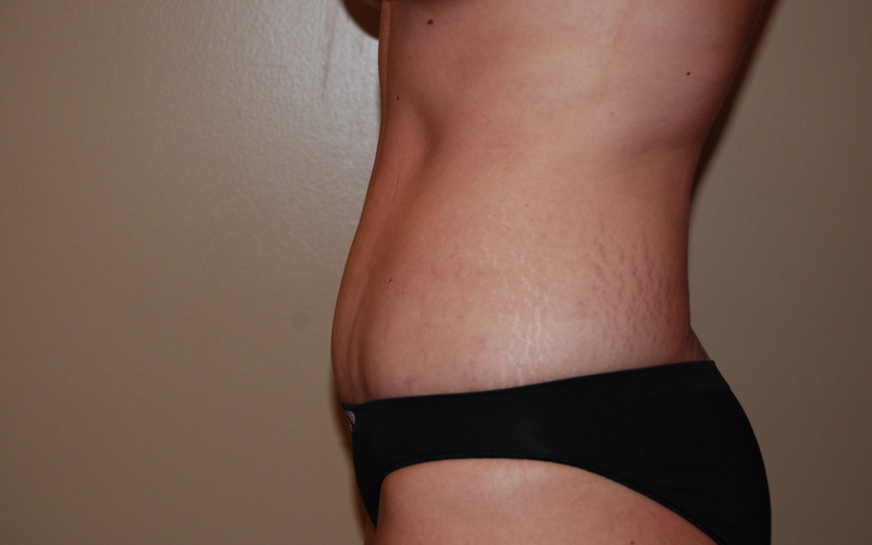 Tummy-Tuck-08 | After Tummy Tuck 5