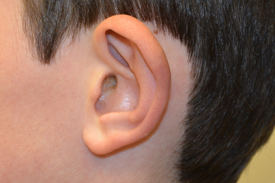 Prominent-Ear-Surgery-06 | Before Prominent Ear Surgery 3
