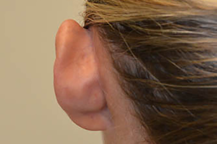 Prominent-Ear-Surgery-05 | Before Prominent Ear Surgery