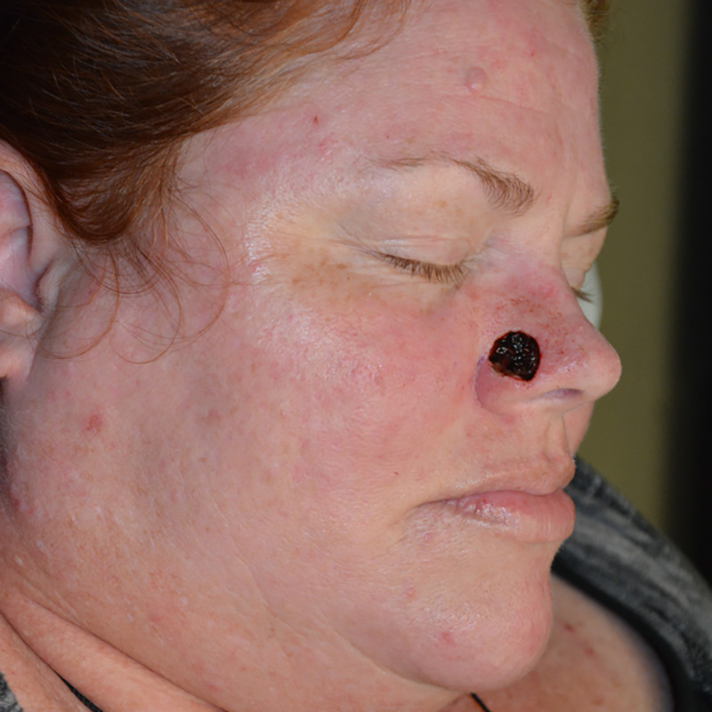 Skin-Cancer-Reconstruction-06 | Before Skin Cancer Reconstruction