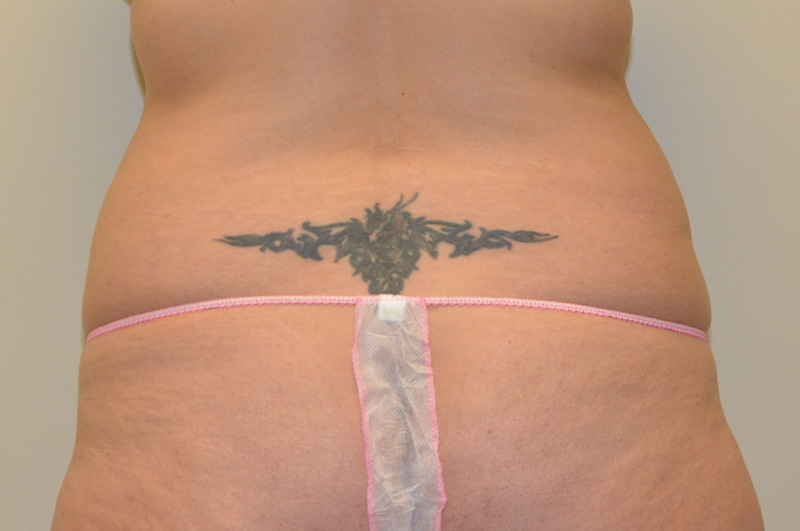 Liposuction-05 | Before Liposuction