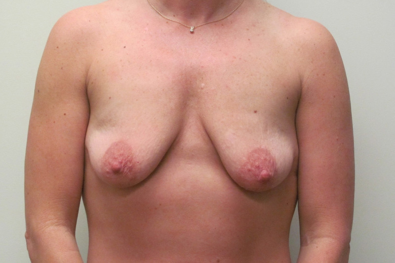 Breast-Lift-and-Augmentation-07 | Before Breast Lift and Augmentation