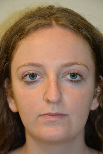 Rhinoplasty-06 | Before Rhinoplasty 5