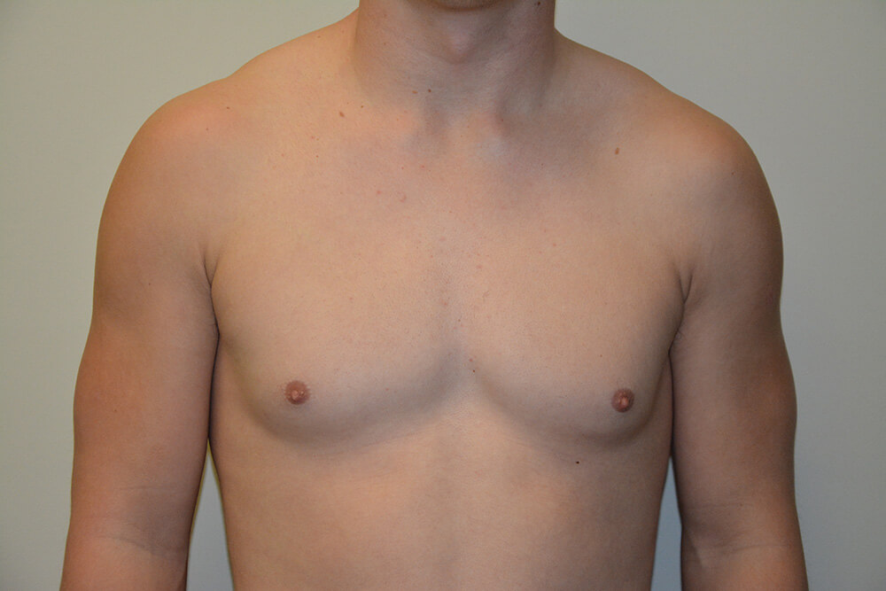 Male-Breast-Reduction-06 | Before Male Breast Reduction