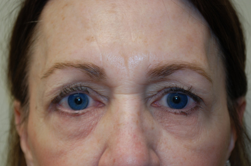 Eyelid-Surgery-07 | Before Eyelid Surgery 1