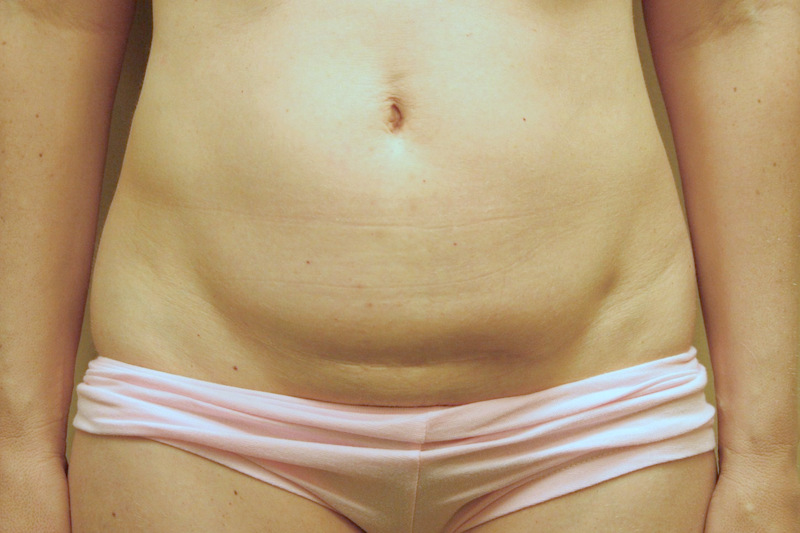 Mini-Tummy-Tuck-06 | Before Mini Tummy Tuck 1