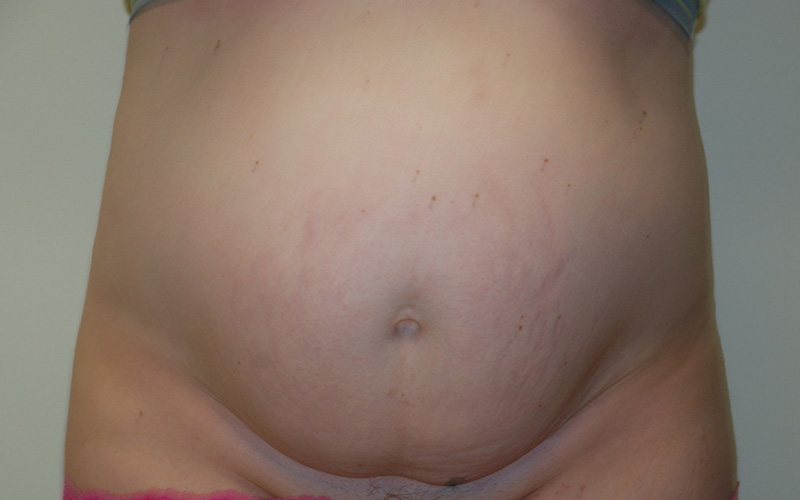 Tummy-Tuck-09 | Before Tummy Tuck