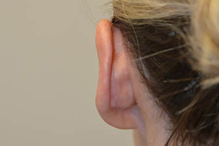 Prominent-Ear-Surgery-05 | After Prominent Ear Surgery