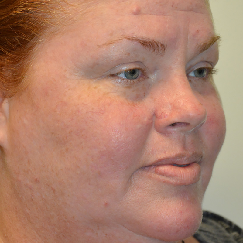 Skin-Cancer-Reconstruction-06 | After Skin Cancer Reconstruction