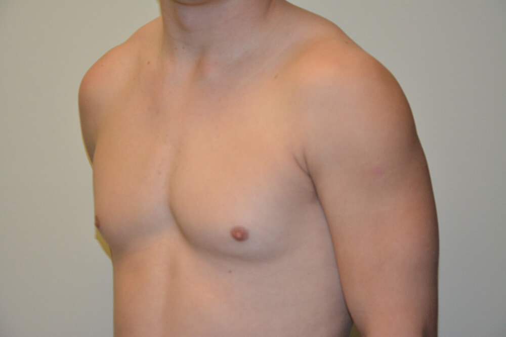 Male-Breast-Reduction-06 | Before Male Breast Reduction 2