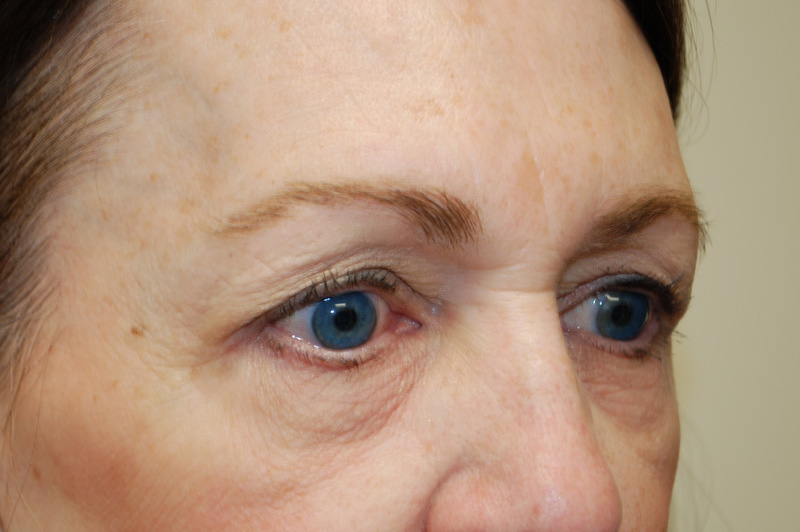 Eyelid-Surgery-07 | Before Eyelid Surgery 2