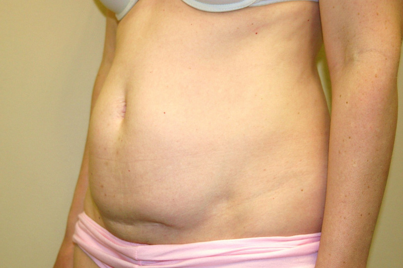 Mini-Tummy-Tuck-06 | Before Mini Tummy Tuck 2