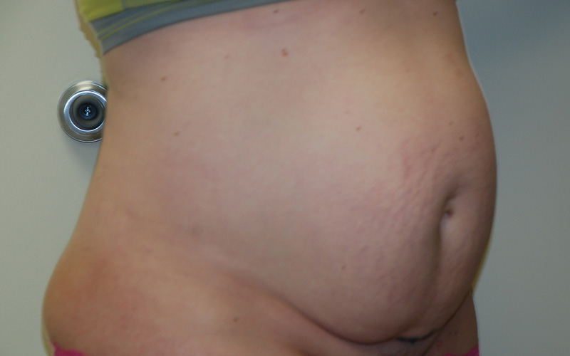 Tummy-Tuck-09 | Before Tummy Tuck 2