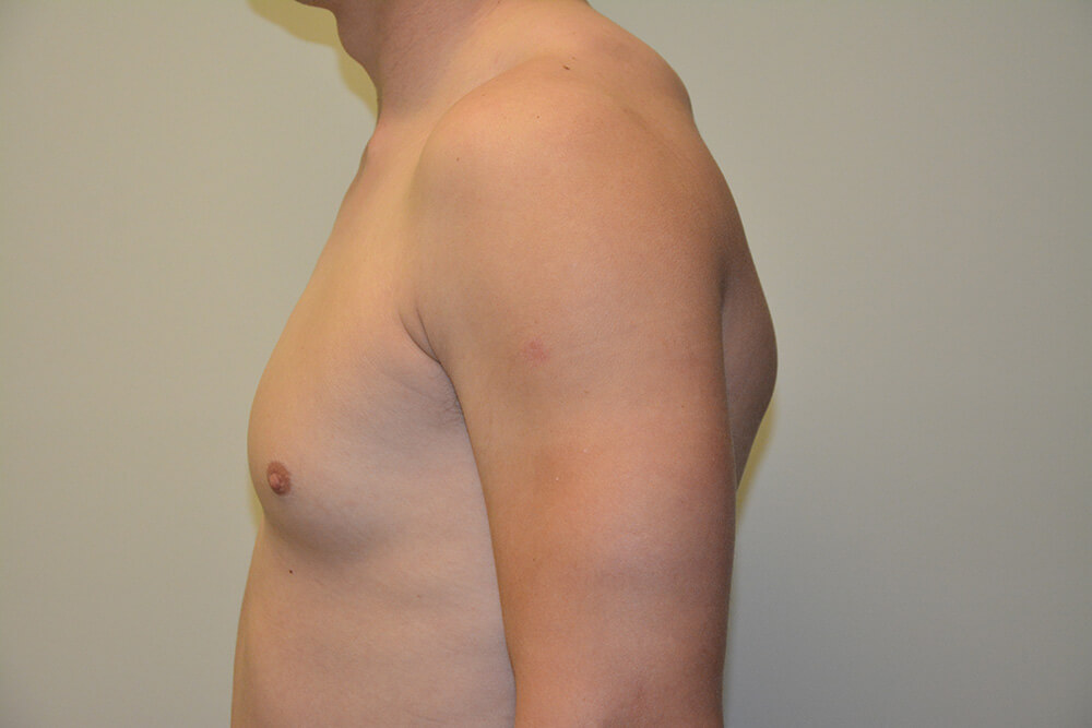 Male-Breast-Reduction-06 | Before Male Breast Reduction 3