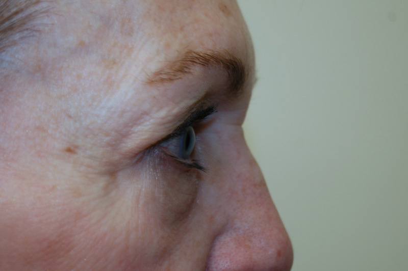Eyelid-Surgery-07 | Before Eyelid Surgery 3