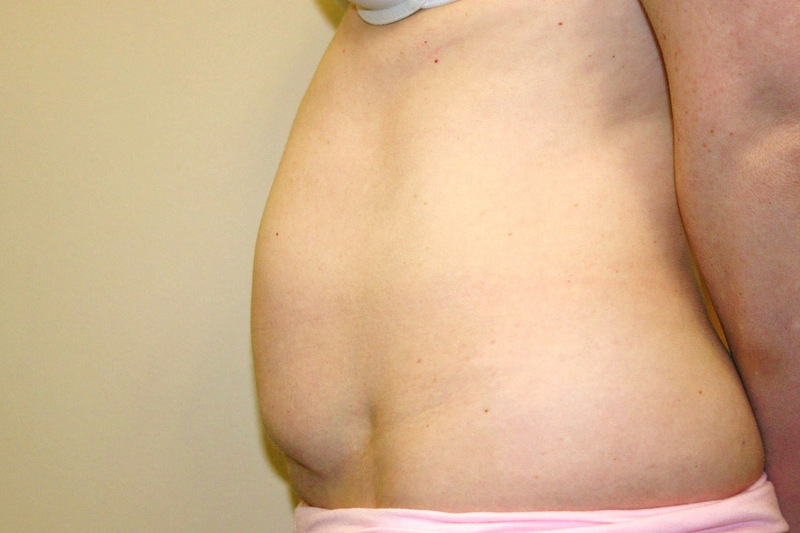 Mini-Tummy-Tuck-06 | Before Mini Tummy Tuck 3