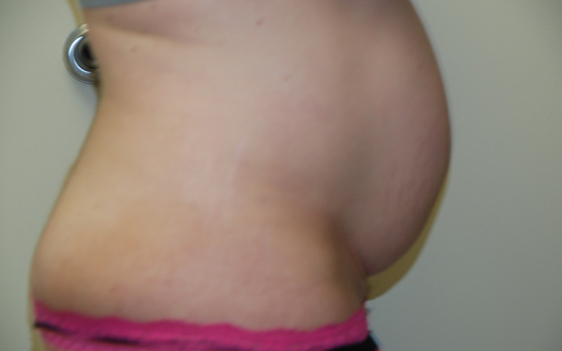 Tummy-Tuck-09 | Before Tummy Tuck 3