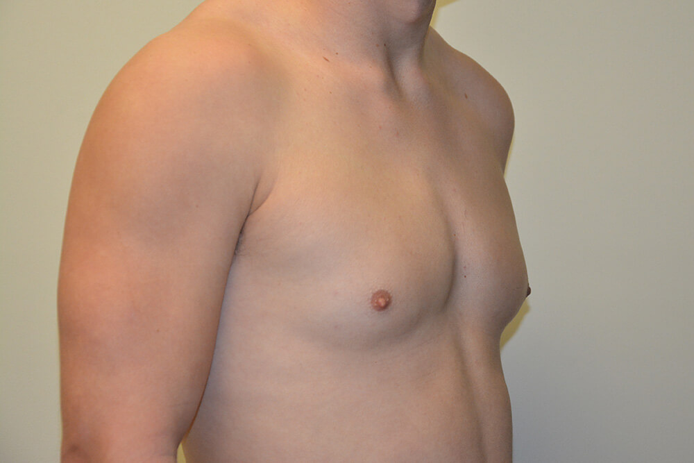 Male-Breast-Reduction-06 | Before Male Breast Reduction 4