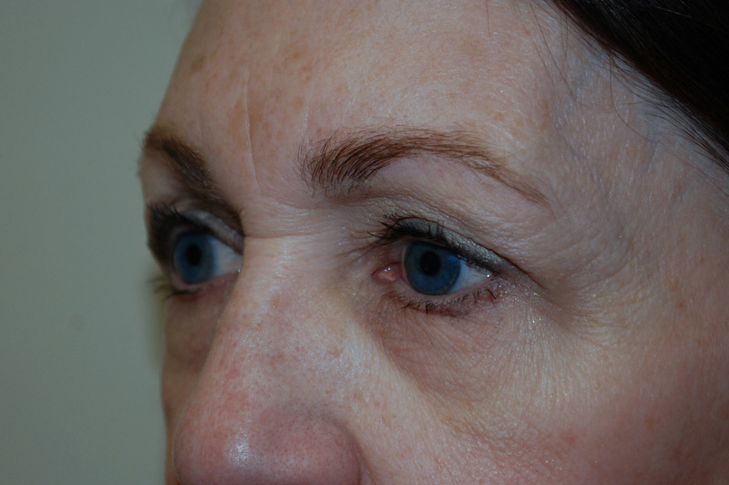 Eyelid-Surgery-07 | Before Eyelid Surgery 4