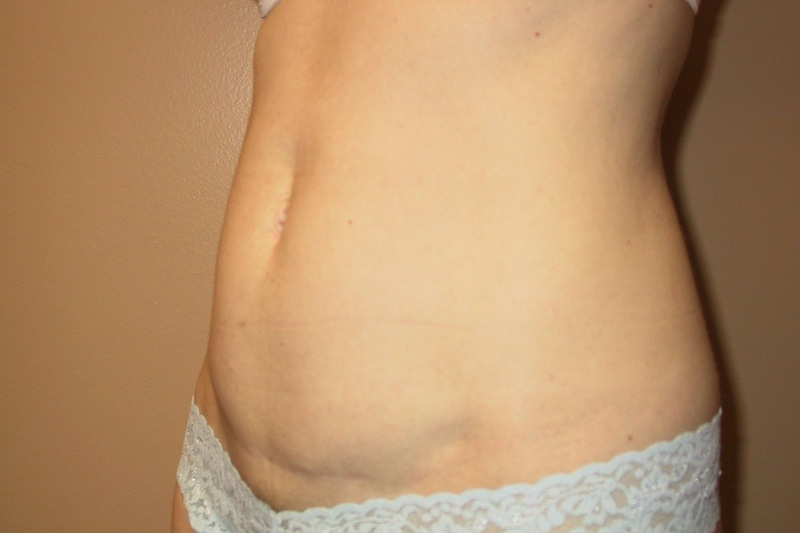 Mini-Tummy-Tuck-06 | After Mini Tummy Tuck 2