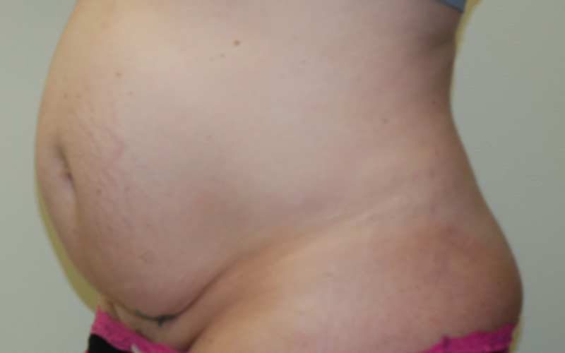 Tummy-Tuck-09 | Before Tummy Tuck 4