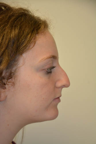 Rhinoplasty-06 | Before Rhinoplasty
