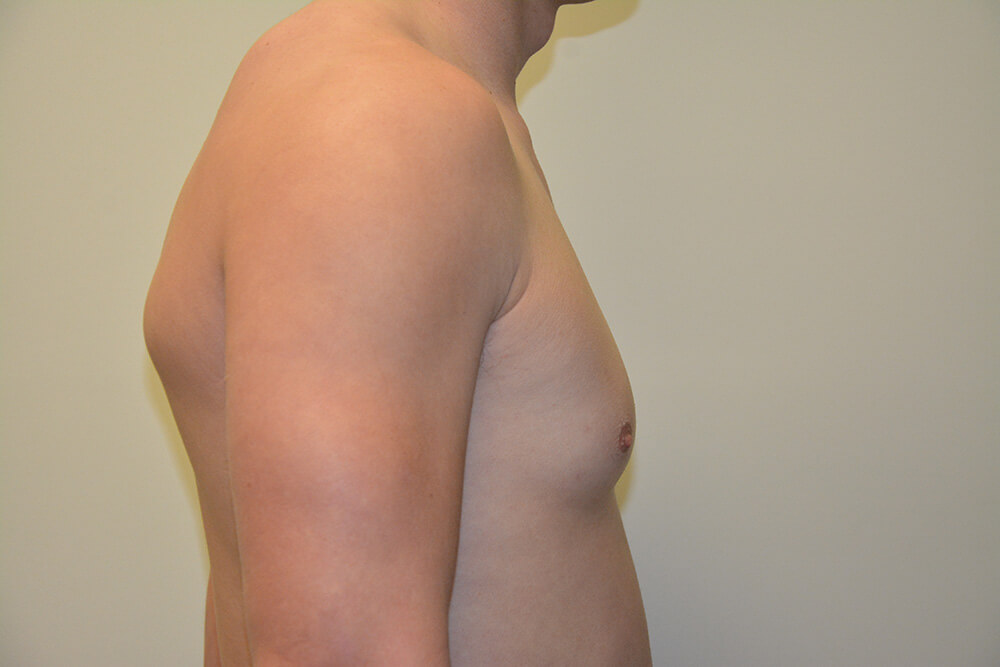 Male-Breast-Reduction-06 | Before Male Breast Reduction 5