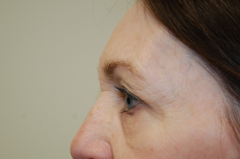 Eyelid-Surgery-07 | Before Eyelid Surgery 5