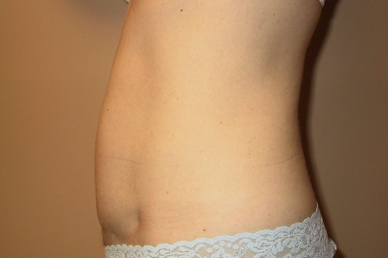 Mini-Tummy-Tuck-06 | After Mini Tummy Tuck 3