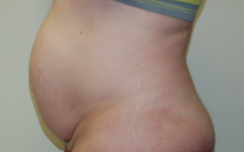 Tummy-Tuck-09 | Before Tummy Tuck 5