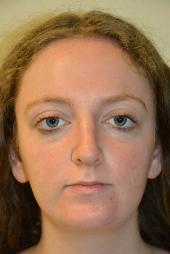 Rhinoplasty-06 | After Rhinoplasty 5