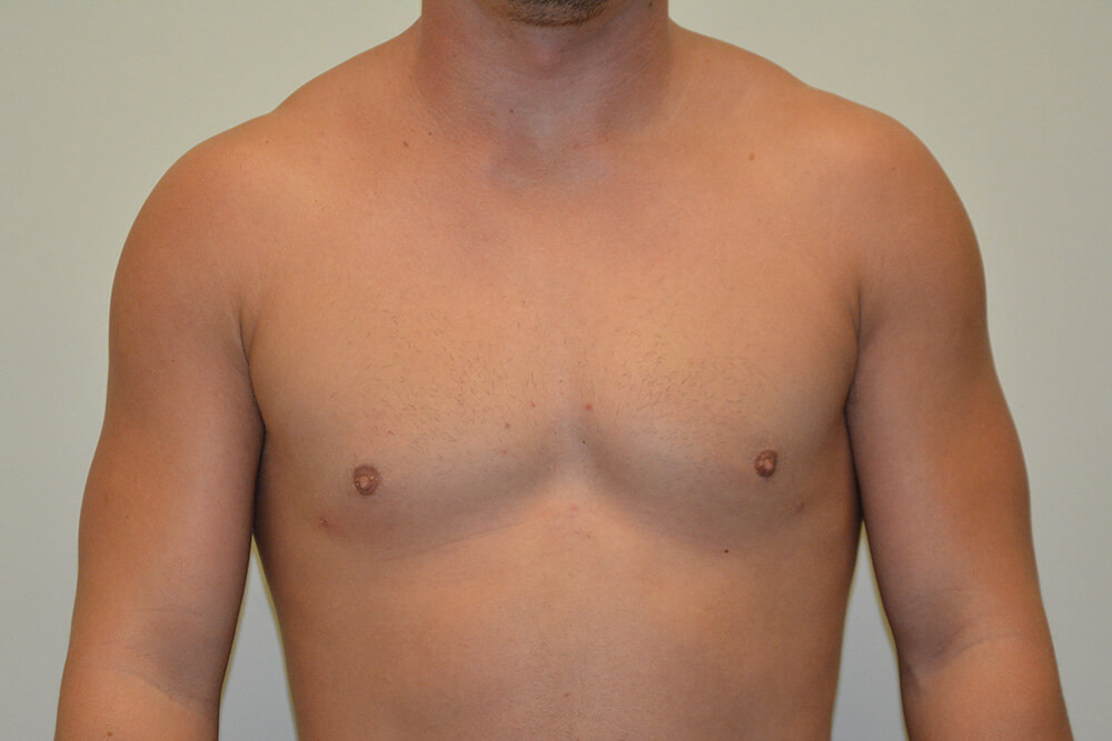 Male-Breast-Reduction-06 | After Male Breast Reduction