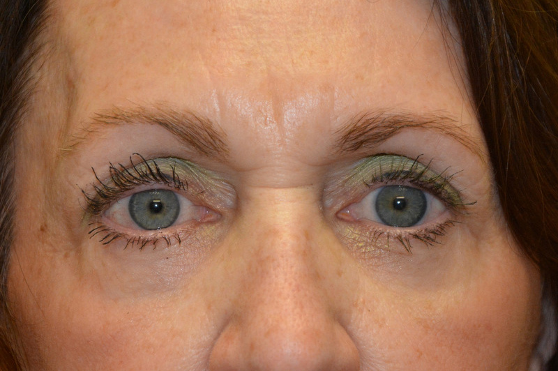 Eyelid-Surgery-07 | After Eyelid Surgery 1
