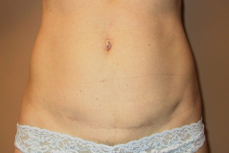Mini-Tummy-Tuck-06 | After Mini Tummy Tuck 1