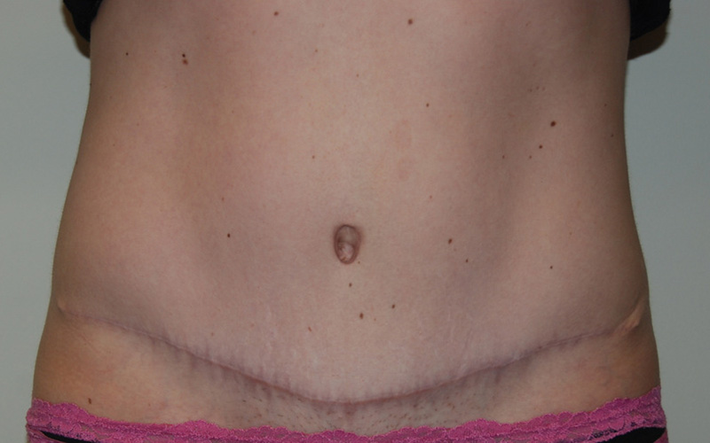 Tummy-Tuck-09 | After Tummy Tuck