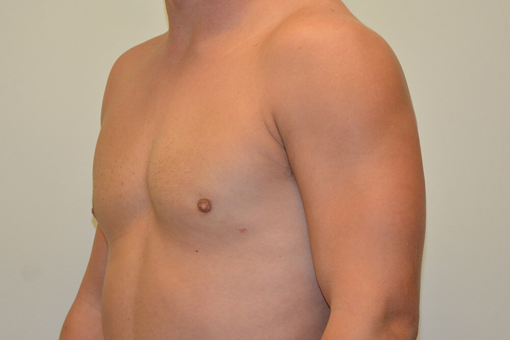 Male-Breast-Reduction-06 | After Male Breast Reduction 2