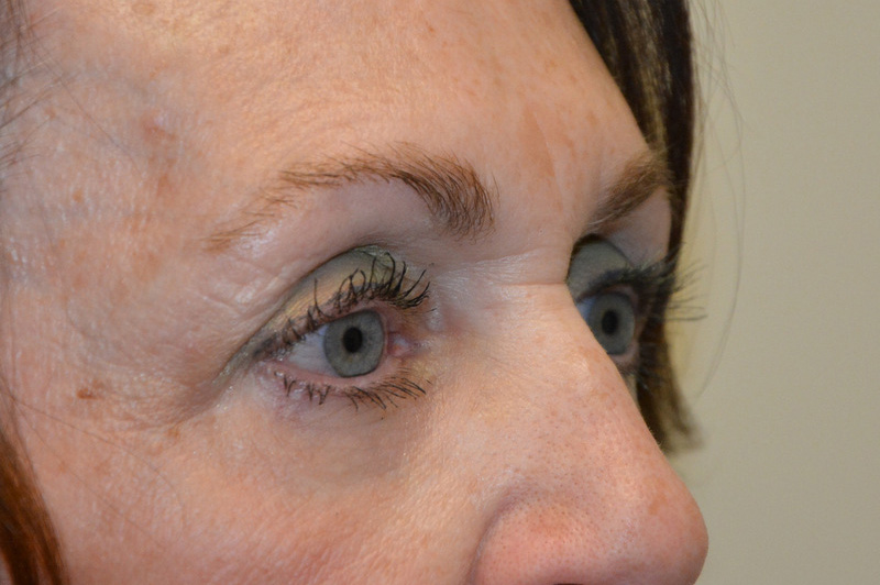 Eyelid-Surgery-07 | After Eyelid Surgery 2