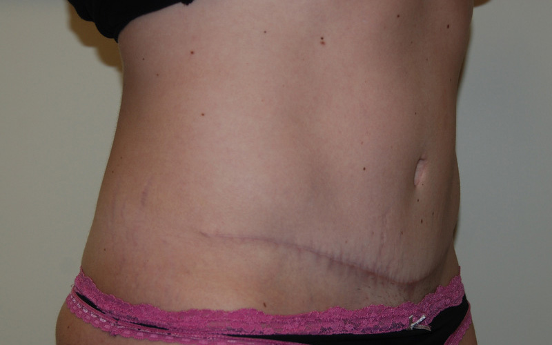 Tummy-Tuck-09 | After Tummy Tuck 2