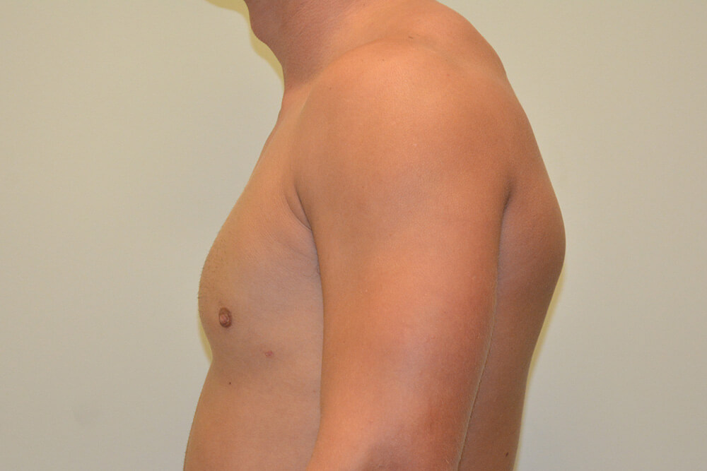 Male-Breast-Reduction-06 | After Male Breast Reduction 3