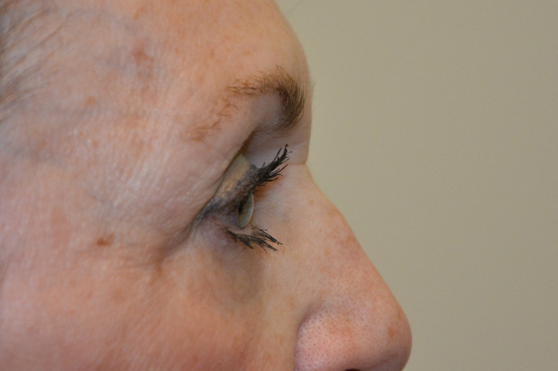 Eyelid-Surgery-07 | After Eyelid Surgery 3