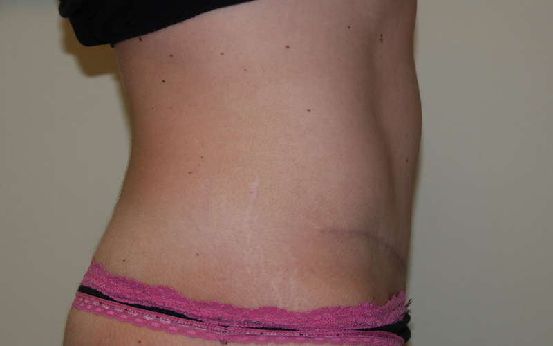 Tummy-Tuck-09 | After Tummy Tuck 3