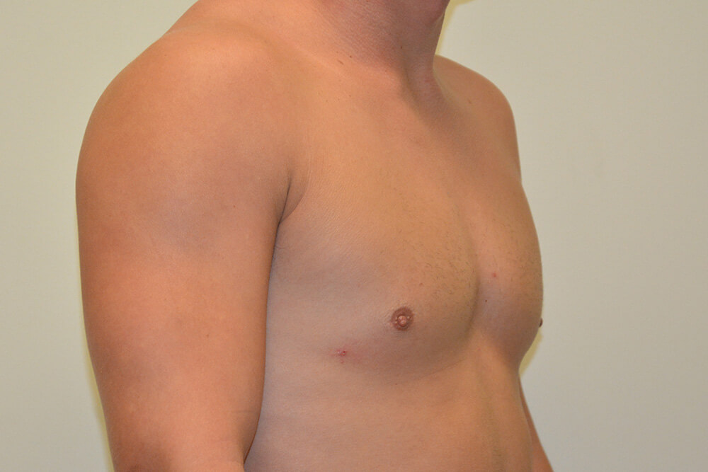 Male-Breast-Reduction-06 | After Male Breast Reduction 4
