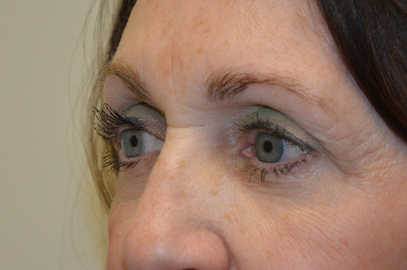 Eyelid-Surgery-07 | After Eyelid Surgery 4