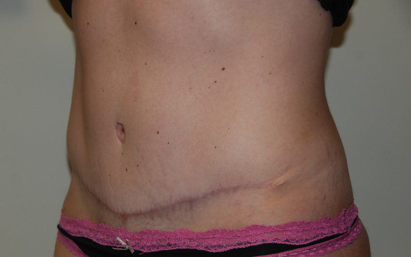 Tummy-Tuck-09 | After Tummy Tuck 4