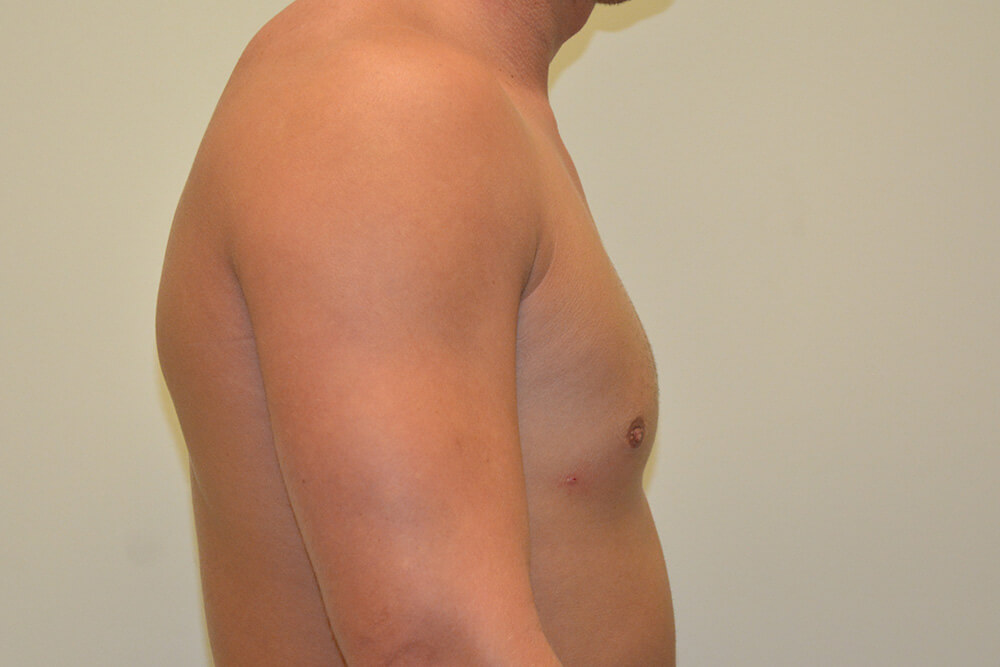 Male-Breast-Reduction-06 | After Male Breast Reduction 5