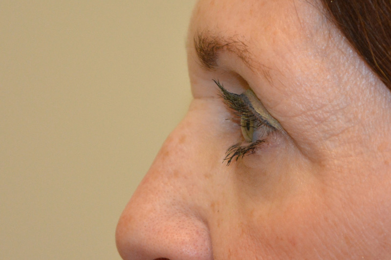 Eyelid-Surgery-07 | After Eyelid Surgery 5
