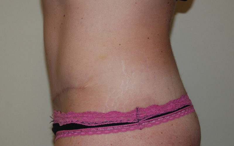 Tummy-Tuck-09 | After Tummy Tuck 5
