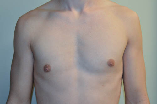 Male-Breast-Reduction-07 | After Male Breast Reduction